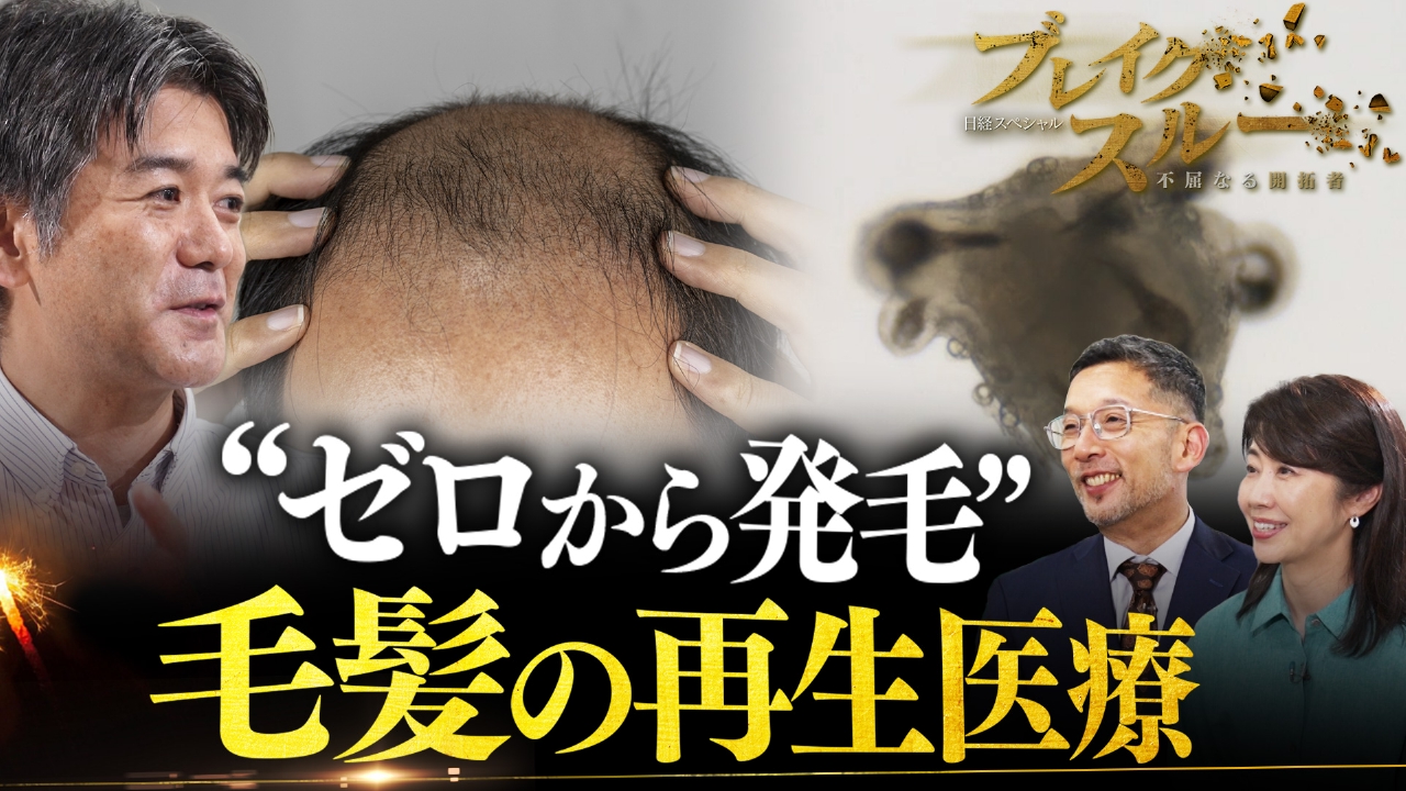 薄毛の悩みを解消！？自分の髪が生える“毛髪再生医療”【傑作選】