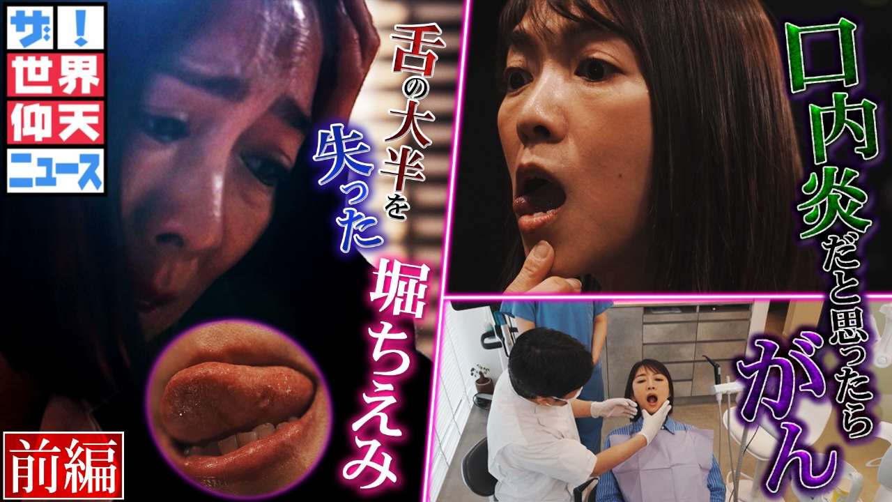 口内炎？命の危機…がんで舌の大半を失った堀ちえみの真実