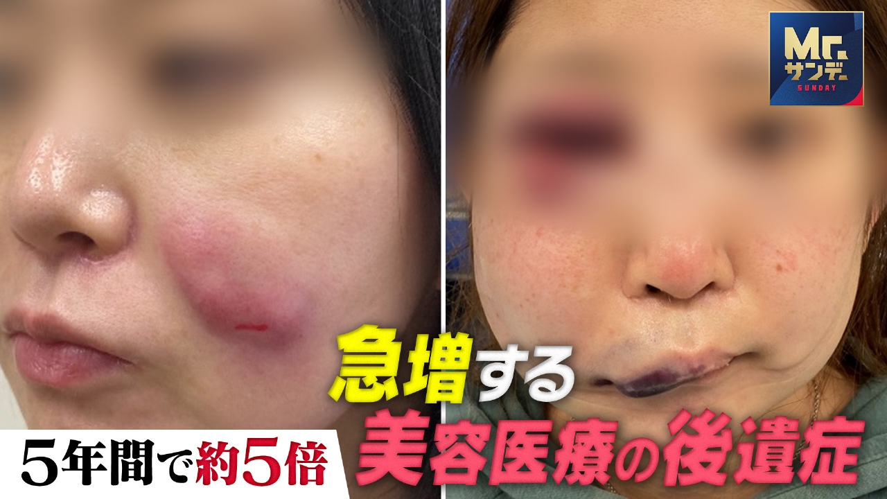 美容医療ブームの裏で急増する後遺症の実態