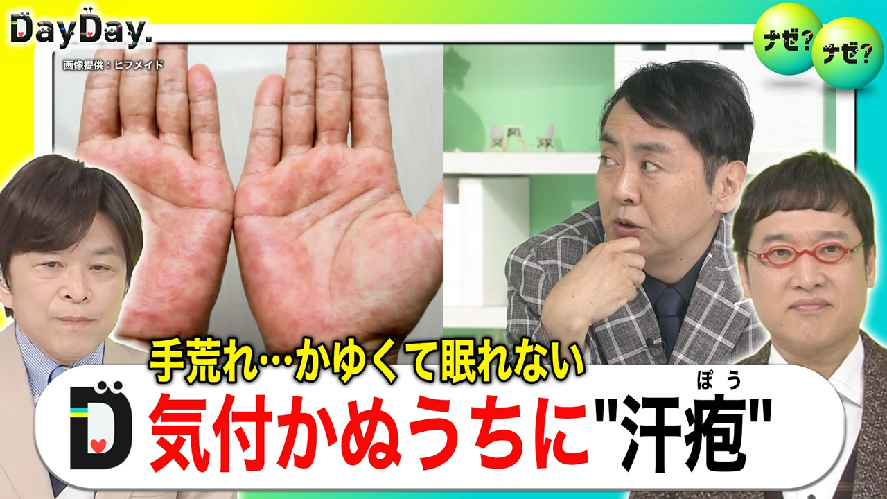 いま､気になる手のかゆみ･荒れ～夏にリスク｢汗疱（かんぽう）｣って？～【ナゼ？ナゼ？】